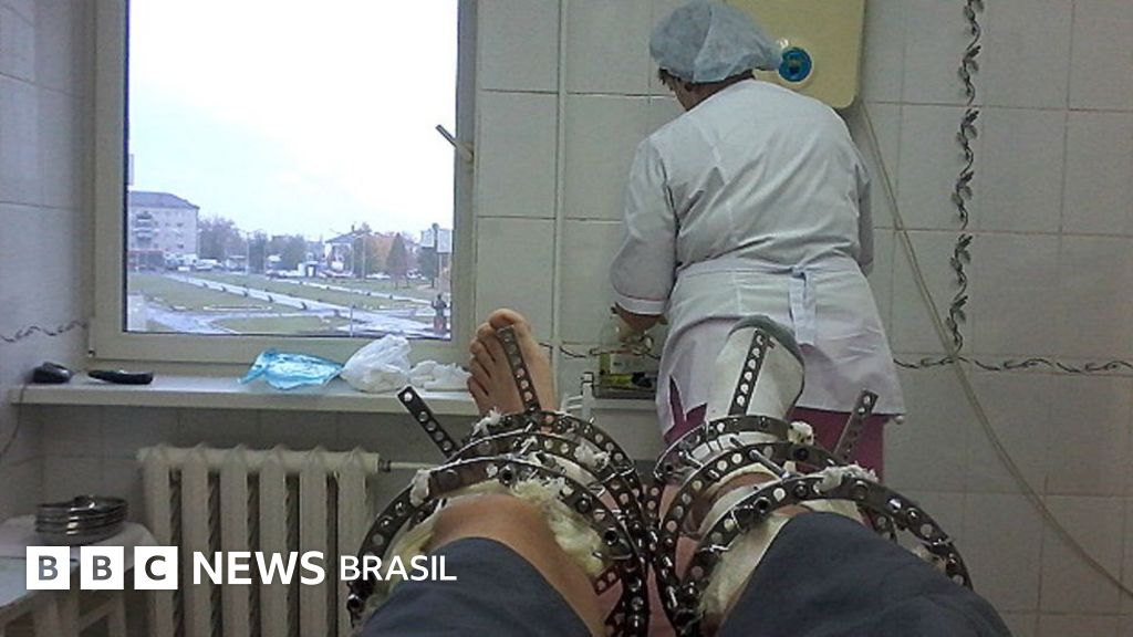 Da panturrilha tempo deformação da nhs recuperação de