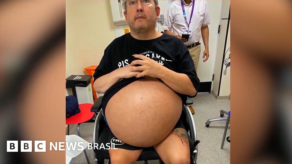 Com rins de 35 kg, britânico faz arriscada cirurgia de remoção