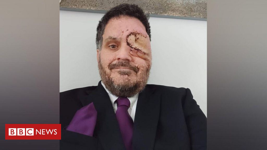 'Fui expulso de restaurante por causa de meu rosto desfigurado'