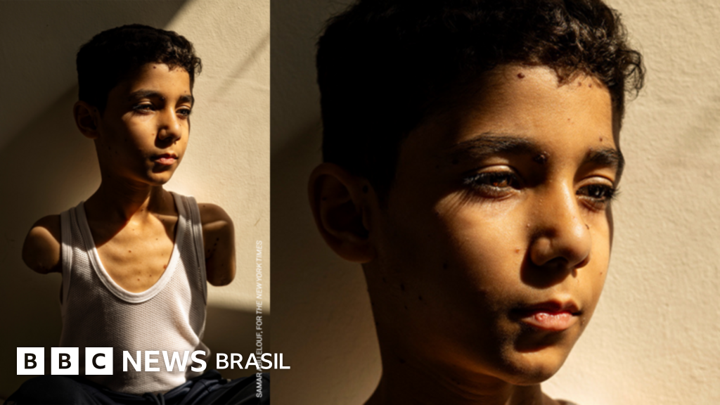 A história da chocante 'foto do ano' de menino palestino mutilado