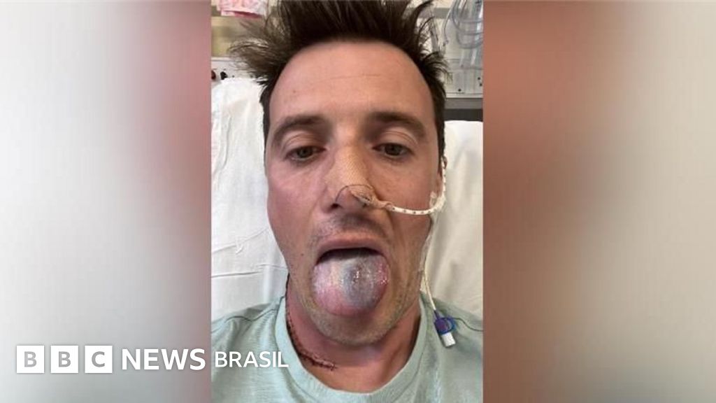 'Quase perdi a língua por um câncer e agora alerto outros homens sobre o risco do HPV'