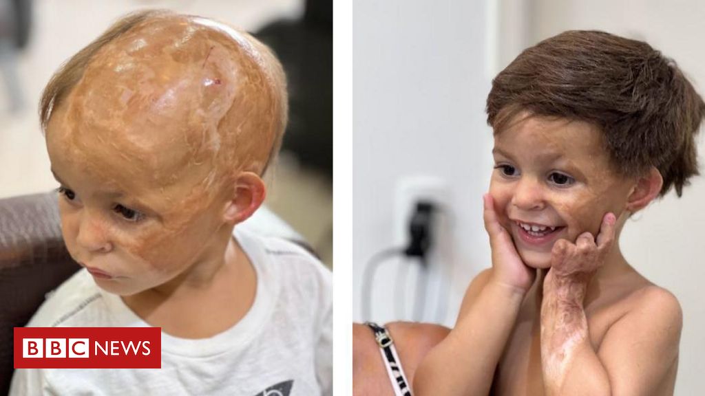 O projeto que recupera a autoestima de crianças que perderam o cabelo em acidentes