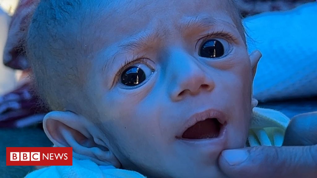 O drama da bebê desnutrida com bloqueio israelense em Gaza: 'Com 5 meses, pesava só 2kg'