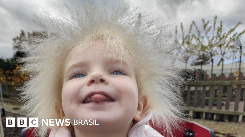 O que é a síndrome do cabelo impenteável: 'o cabelo da minha filha é lindo'