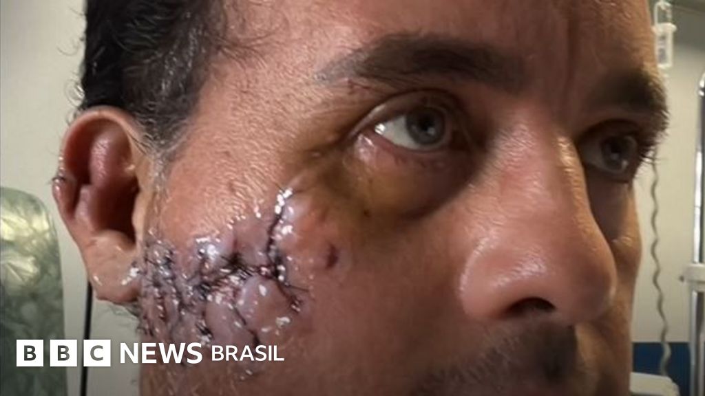 O homem que sobreviveu a uma mordida de tubarão na cabeça