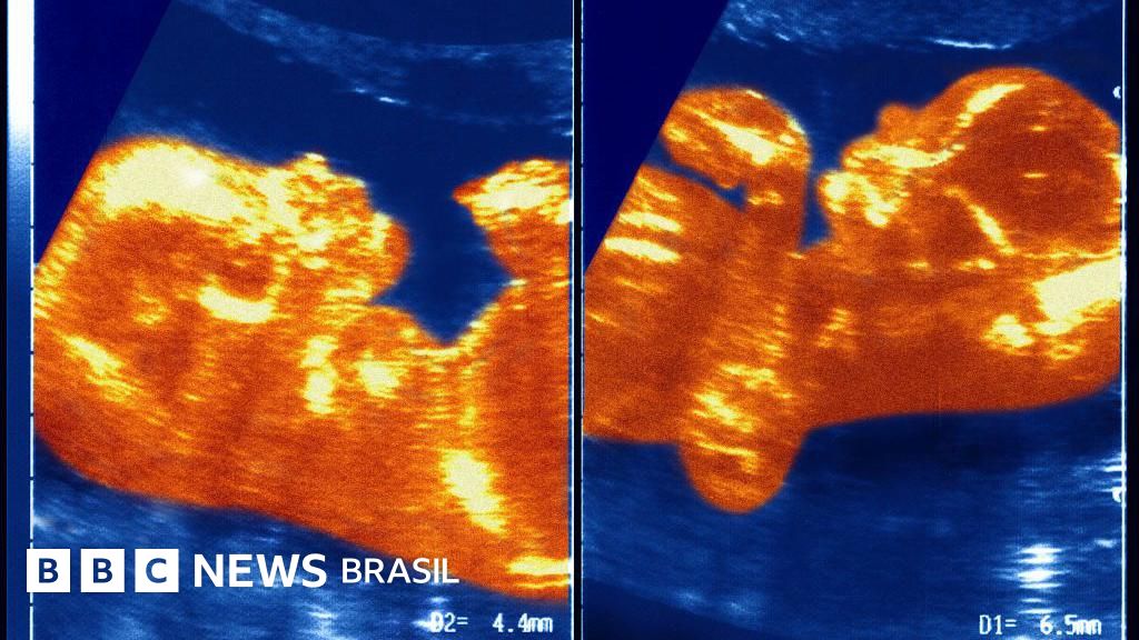 O caso inédito da brasileira que carrega DNA do irmão gêmeo