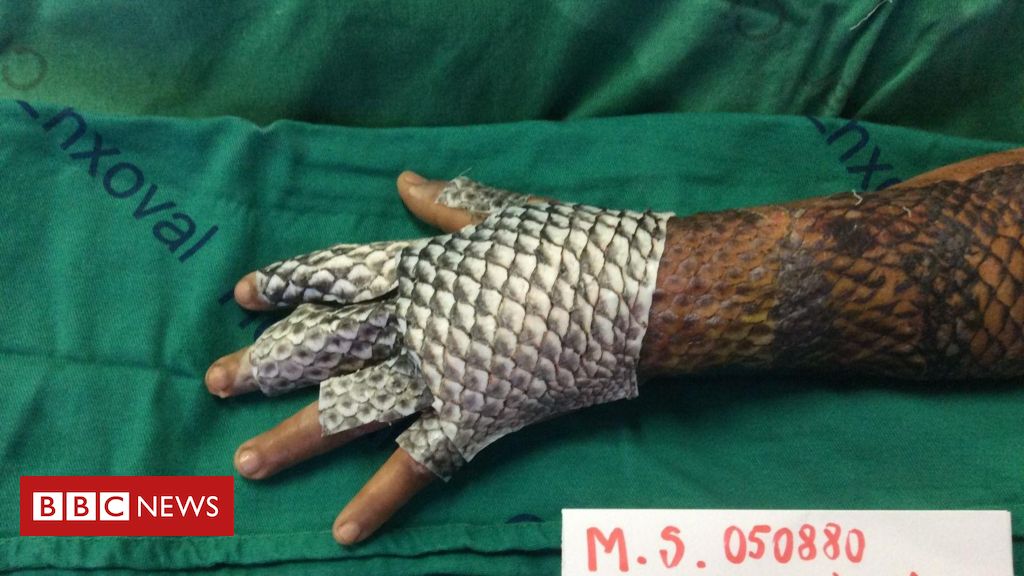 Brasileiros testam pele de tilápia como tratamento para queimadura e em cirurgias de mudança de sexo