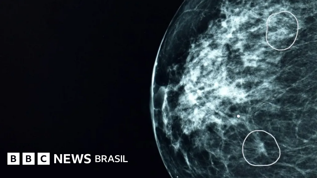 A ferramenta de IA capaz de detectar tumores que passaram desapercebidos por médicos