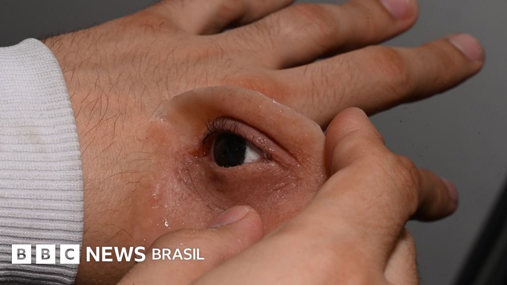 Como próteses gratuitas estão mudando a vida de pessoas após tratamento contra câncer