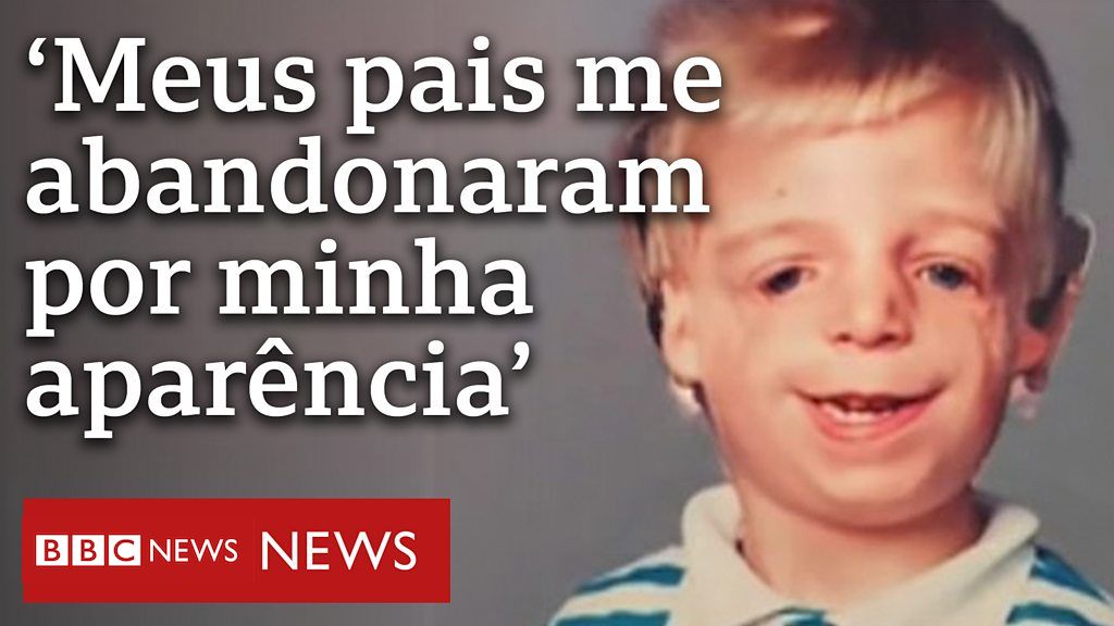 Síndrome de Treacher Collins: 'Odiava o meu rosto, mas agora tenho orgulho dele'