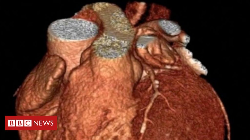 Infarto: os sintomas menos conhecidos de ataque cardíaco - BBC