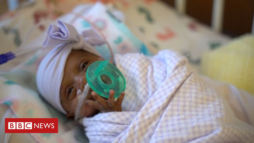 Menor Bebe Do Mundo A Sobreviver Deixa Hospital E Vai Para Casa Nos Eua c News Brasil