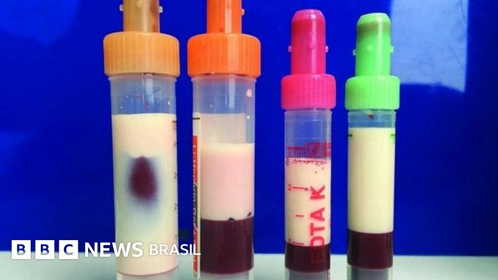 O homem cujo sangue ficou branco de tanta gordura - BBC News Brasil