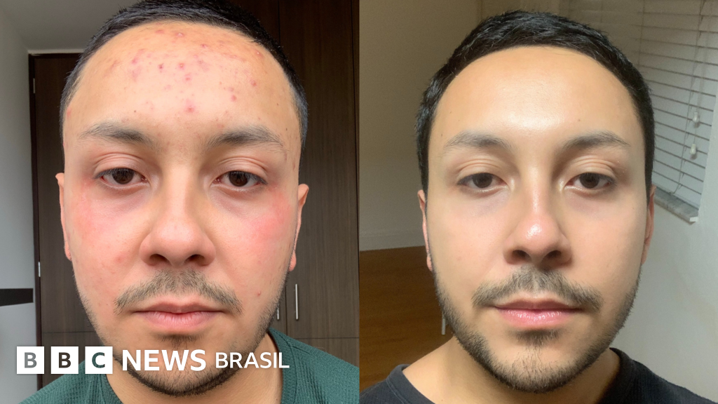 O que aprendi em minha desesperada busca por solução para acne severa