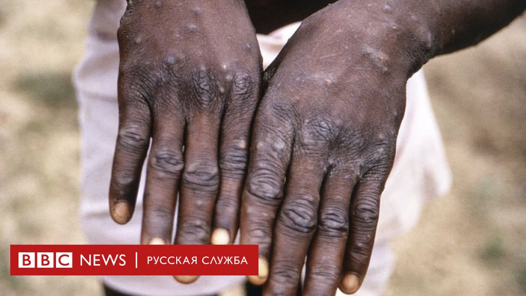 В США нашли обезьянью оспу. Впервые с 2003 года BBC News Русская служба