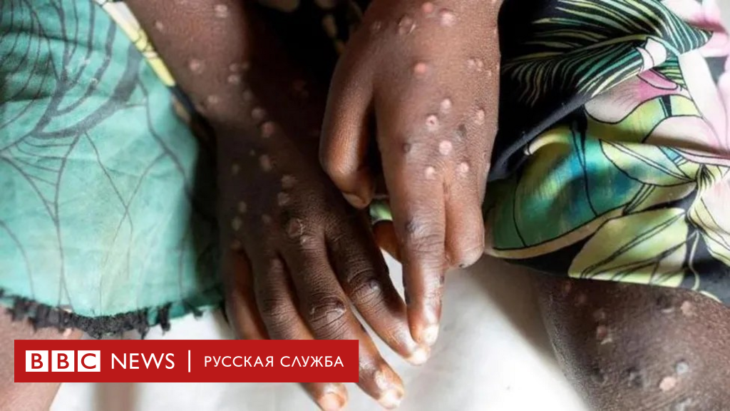 WHO expert: mpox (monkeypox) is not a new covid, methods to combat the virus are clear