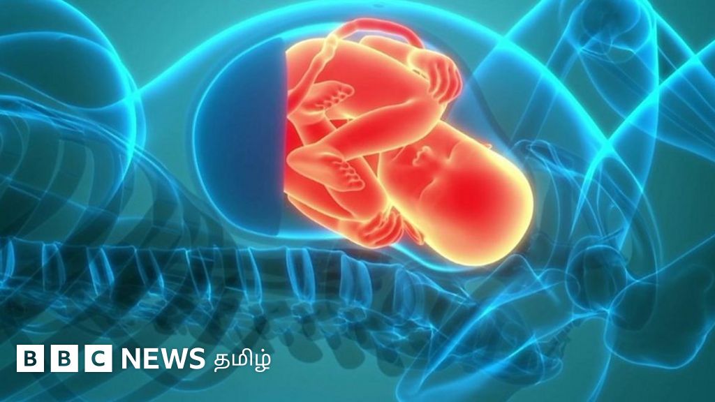 சிசேரியன் மூலம் குழந்தை பெறுவது அதிகரிப்பது ஏன்? காரணங்களும், தவிர்க்கவேண்டியவையும்