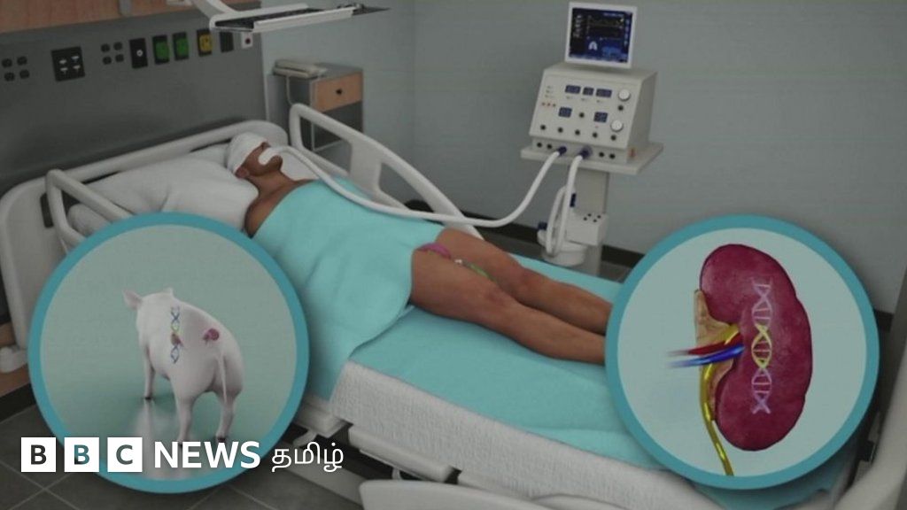 மனிதருக்கு பன்றியின் சிறுநீரகம்: அமெரிக்க அறுவை சிகிச்சை நிபுணர்கள் சாதனை