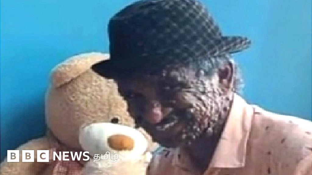 மரபணு குறையால் மாறிய முகம் - சவாலை சாதனையாக மாற்றிய யுவராஜ் 'டீச்சர்'