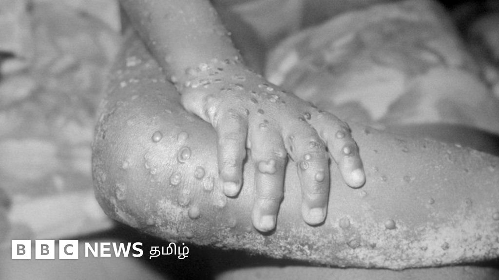 குரங்கம்மையின் அறிகுறிகள் என்ன? - உலகெங்கும் 11 நாடுகளில் பரவல்