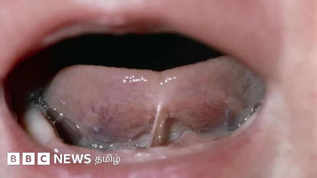 உடலும் நலமும்: நாக்கு இயக்க குறைபாடு எவ்வளவு அபாயகரமானது?