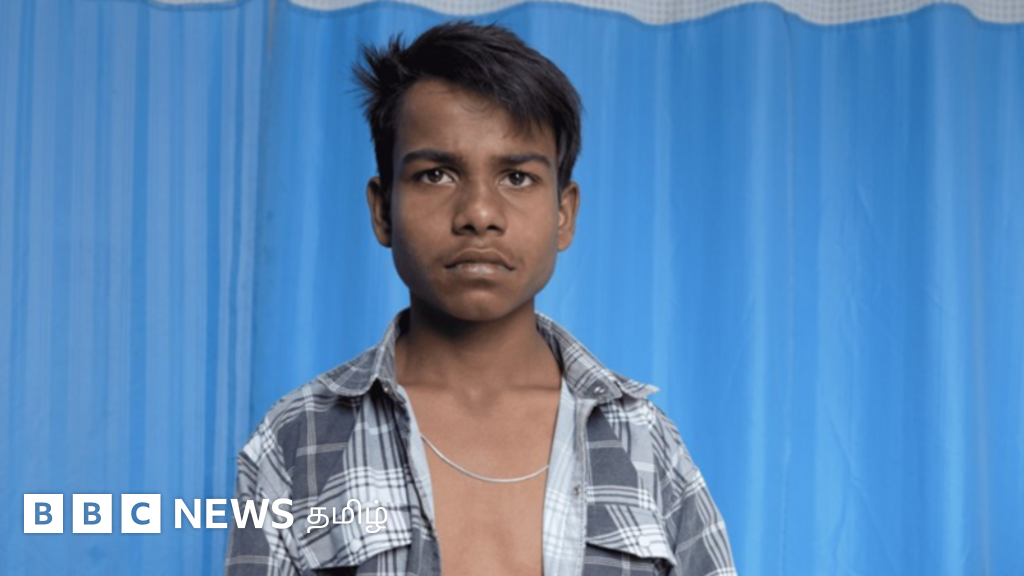 நான்கு கால்களுடன் 17 ஆண்டுகள் வாழ்ந்த சிறுவன் - மறுவாழ்வு கொடுத்த எய்ம்ஸ் மருத்துவர்கள்