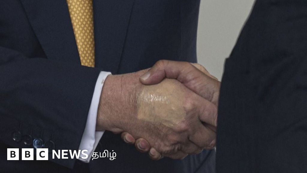 டிரம்ப் கையில் தென்படும் மாற்றத்திற்கு காரணமான நீண்ட கால உடல்நல பாதிப்பு என்ன தெரியுமா?