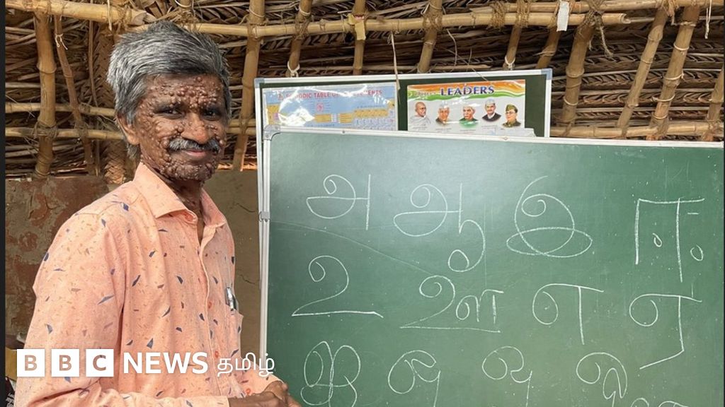 மரபணு குறைபாட்டால் மாறிய முகம்: சவால்களை சாதனையாக மாற்றிய யுவராஜ்