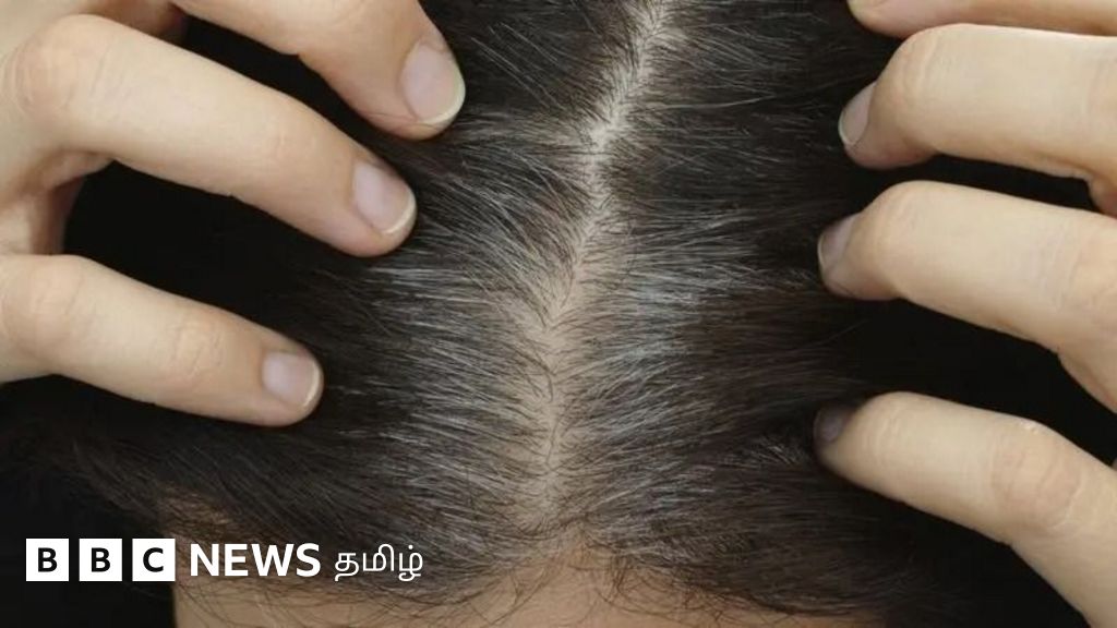 இளநரை வராமல் தவிர்ப்பது எப்படி? ஒரு நரைமுடியை பிடுங்கினால் அதிக வெள்ளை முடி வருமா?