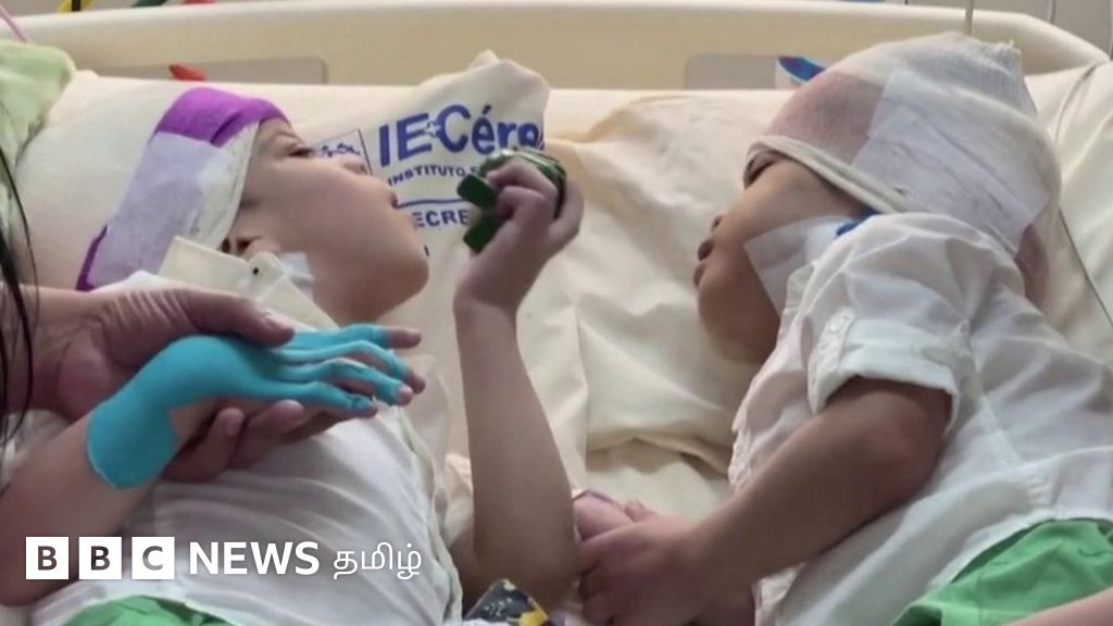 தலை ஒட்டிப்பிறந்த இரட்டையர்களுக்கு வெற்றிகரமாக அறுவை சிகிச்சை - மூன்று வயதில் முதல் சந்திப்பு