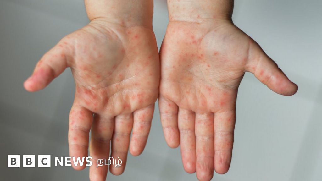 தக்காளி காய்ச்சல் என்றால் என்ன? அறிகுறிகள் - தற்காப்பு என்ன?