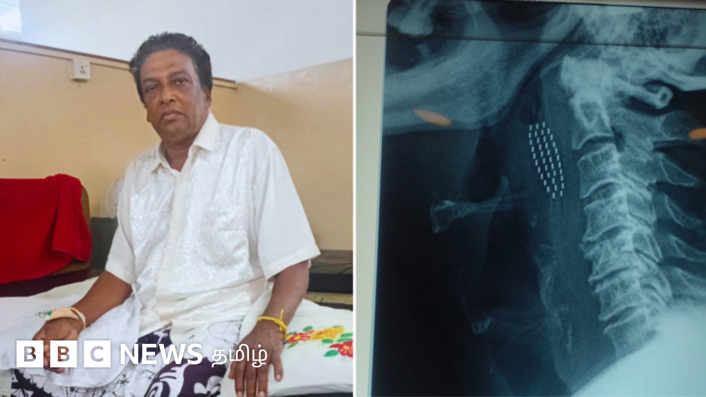 குளியலறையில் வழுக்கி விழுந்த நபரின் தொண்டைக்குள் சிக்கிய பல் துலக்கும் பிரஷின் முன் பகுதி - என்ன ஆனார்?