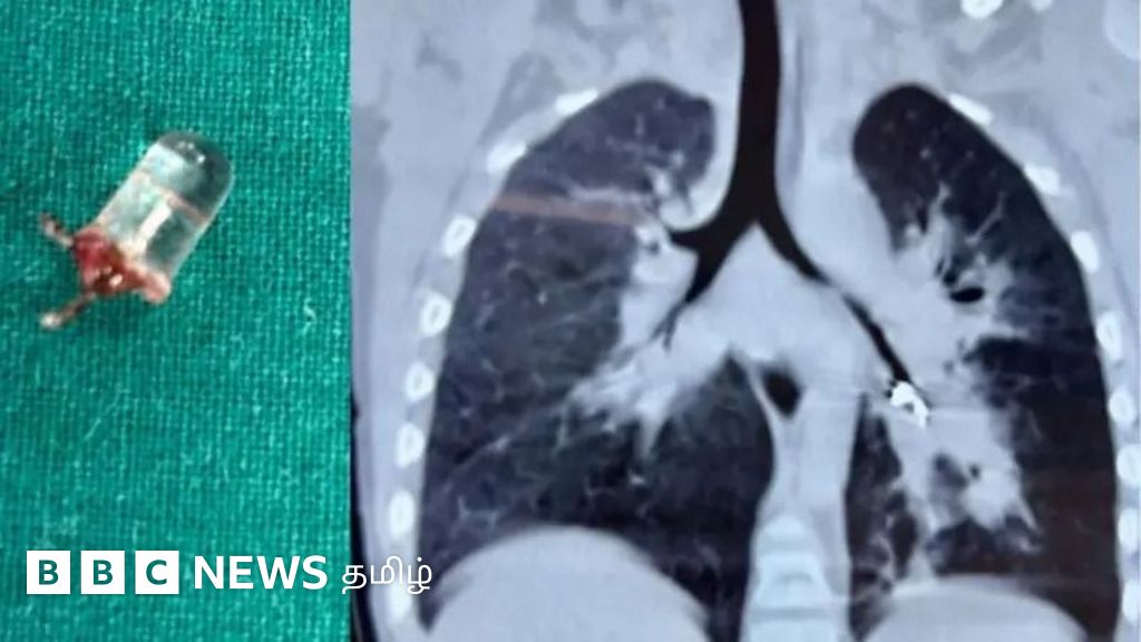 நுரையீரலில் 'எல்இடி' விளக்கு சிக்கியதால் 3 மாதங்கள் அவதிப்பட்ட குழந்தை - என்ன நடந்தது?