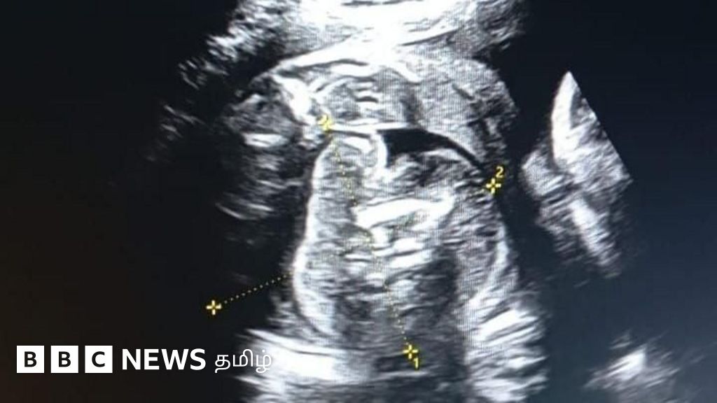 மகாராஷ்டிரா: பெண்ணின் கருவில் இருந்த குழந்தை வயிற்றில் ஒரு கரு உருவானது எப்படி?