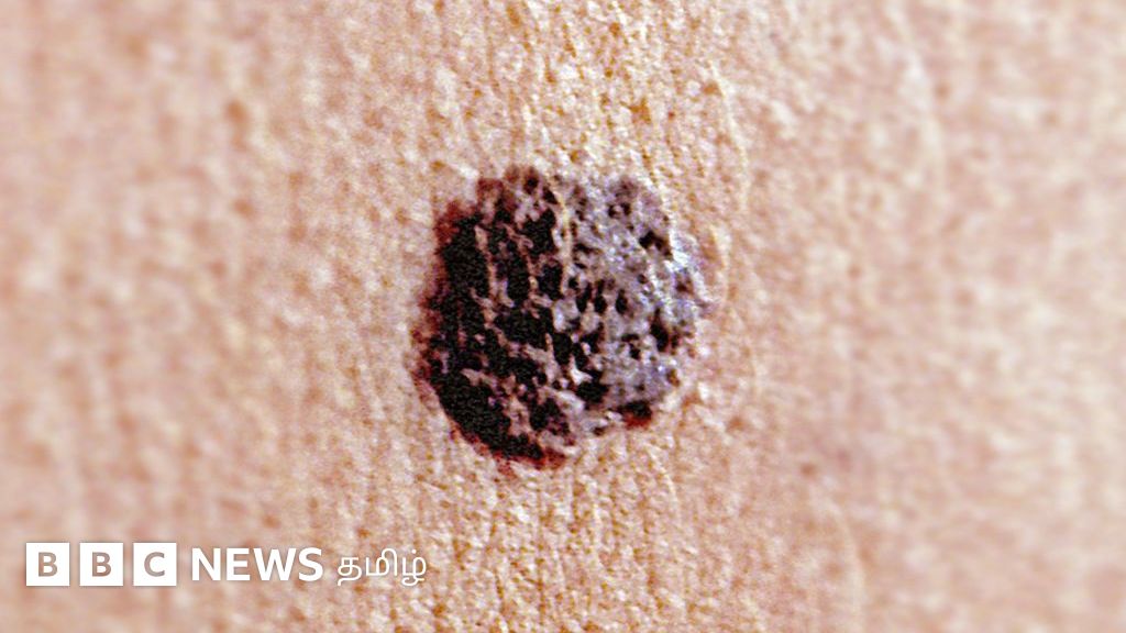 தோல் புற்றுநோய் ஏன் ஏற்படுகிறது? தடுப்பதற்கு என்ன வழி? மருத்துவர்கள் கூறுவது என்ன?