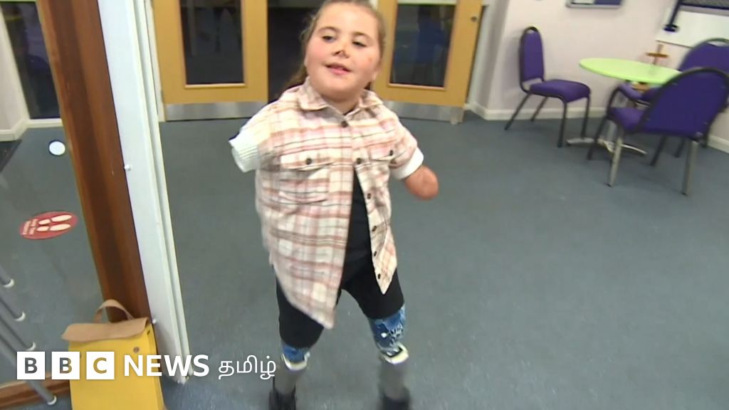 கணினி முறை மூட்டு, செயற்கைக் கால்கள் பெற்ற உலகின் முதல் சிறுமி