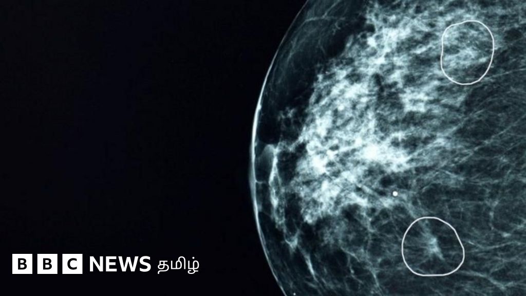 மருத்துவர்களால் பார்க்க முடியாத புற்றுநோய் கட்டிகளை கண்டறியும் 'மியா'