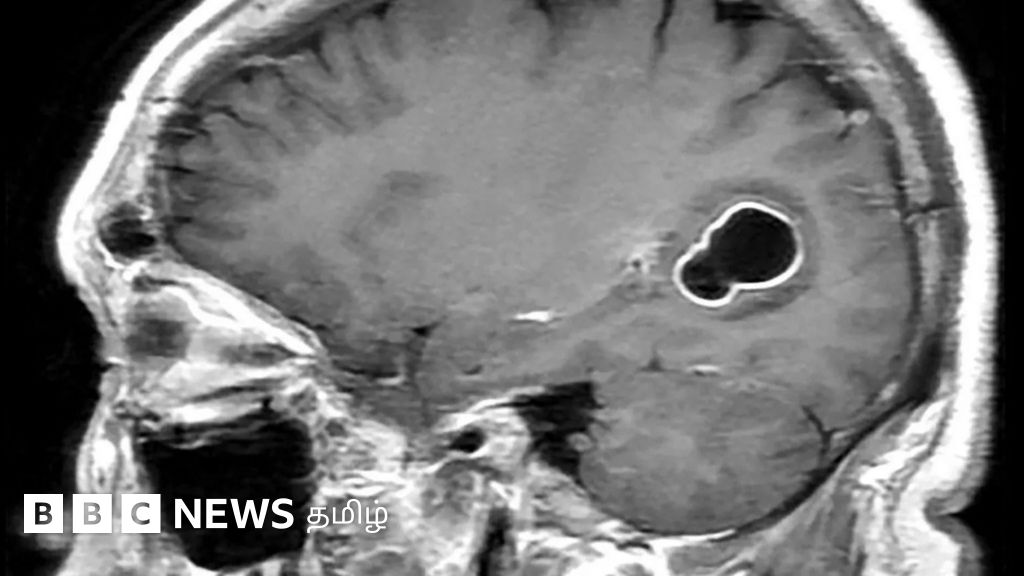 நமது மூளைக்குள் புழுக்கள் எப்படி நுழைகின்றன? தடுப்பதற்கு என்ன செய்ய வேண்டும்?