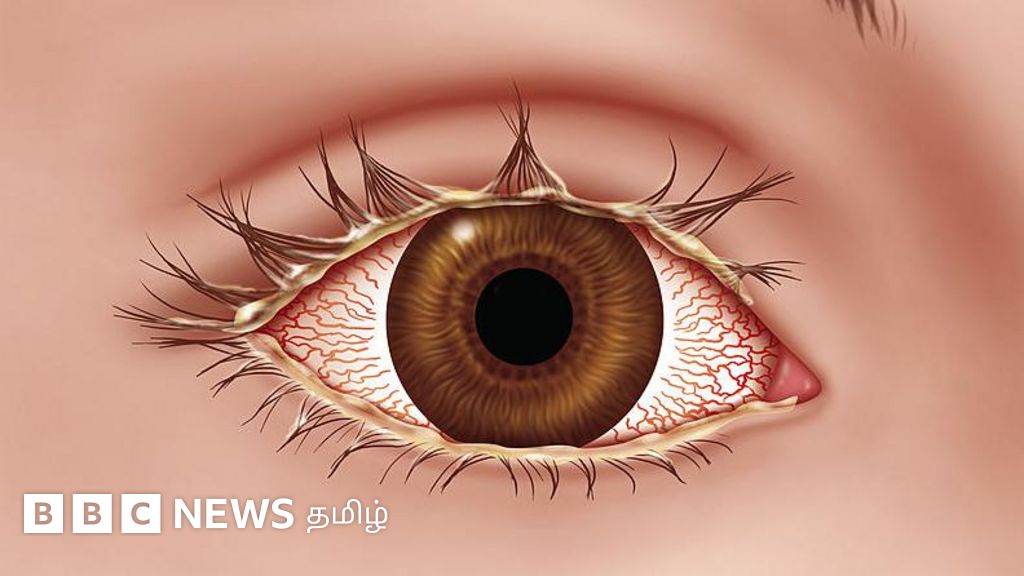 தமிழகத்தில் அதிகரிக்கும் மெட்ராஸ் ஐ: என்ன செய்யவேண்டும், என்ன செய்யக்கூடாது?  