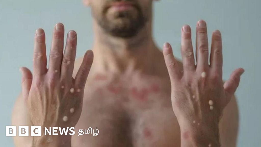 ஆணுறுப்பில் குரங்கம்மை புண்கள்: ' தீயில் இருப்பது இருக்கும்' - பாதிக்கப்பட்ட பிரேசில் மனிதரின் அனுபவம்