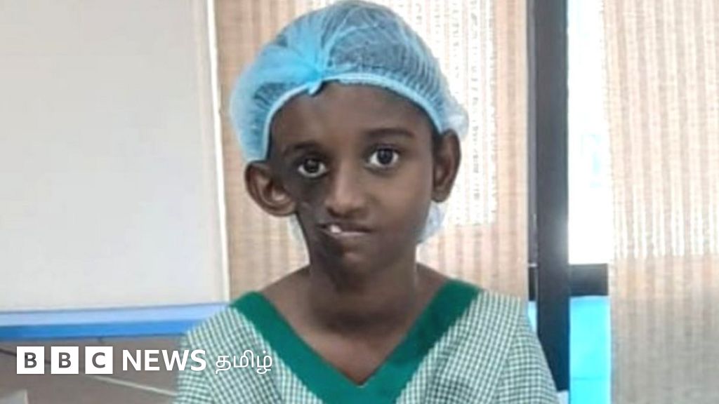 அரியவகை முகச்சிதைவு நோய்: 