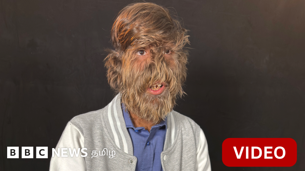 ஓநாய்-மனித நோயால் முகம் முழுக்க வளர்ந்த முடி - இந்திய இளைஞர் செய்த கின்னஸ் சாதனை