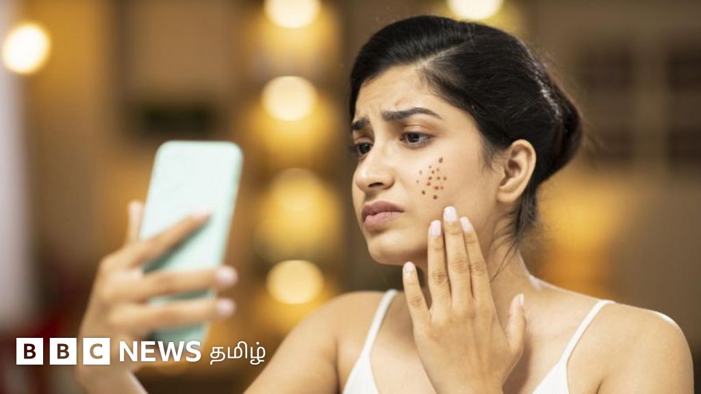 முகப்பரு ஏன் வருகிறது? அதை எப்படி தவிர்ப்பது?