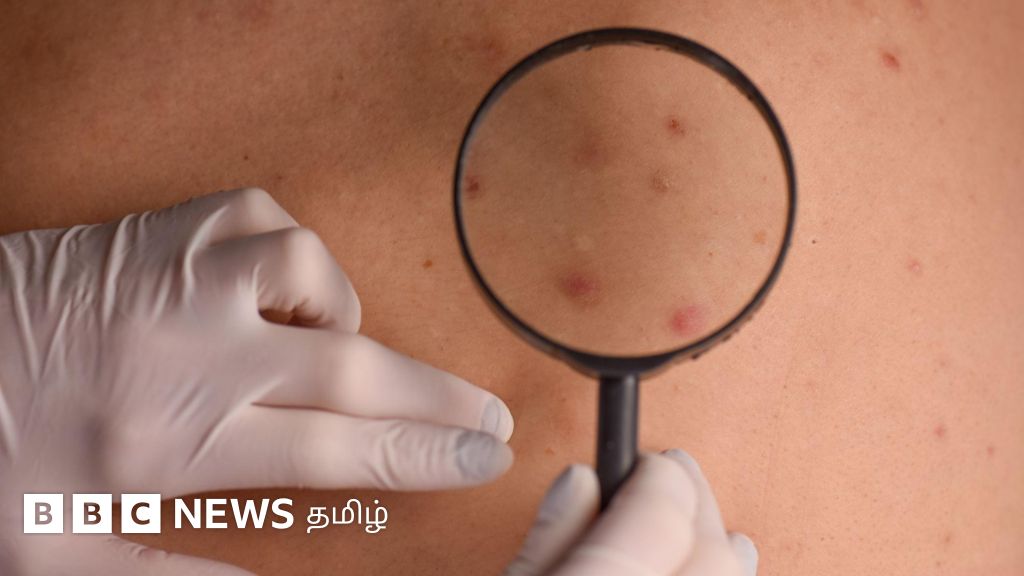 தோல் புற்றுநோய் வரும் ஆபத்து யாருக்கு அதிகம்? அறிகுறிகளும் சிகிச்சையும் 