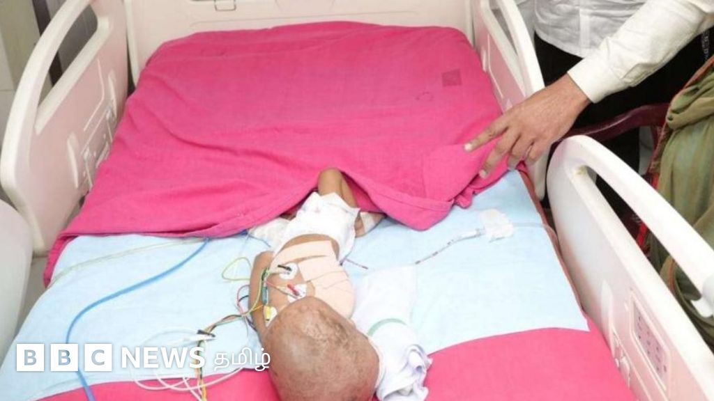 அரசு மருத்துவமனையில் கை அகற்றப்பட்ட ஒன்றரை வயது குழந்தை மரணம் - என்ன நடந்தது?