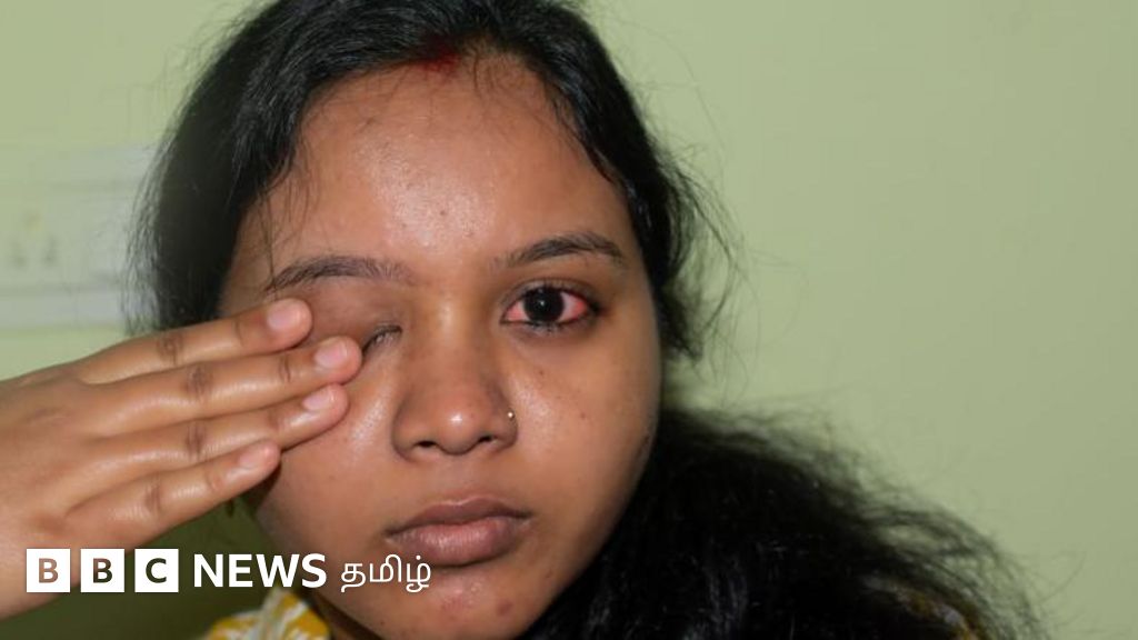 'மெட்ராஸ் ஐ' கண்களை பார்த்தாலே பரவுமா? தற்காப்பு, அறிகுறிகள், சிகிச்சைகள் என்ன?