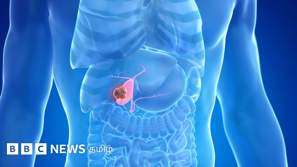 பித்தப்பை புற்றுநோய்: எந்தெந்த அறிகுறிகளை அலட்சியம் செய்யக்கூடாது? யாருக்கு வரும் வாய்ப்பு அதிகம்?
