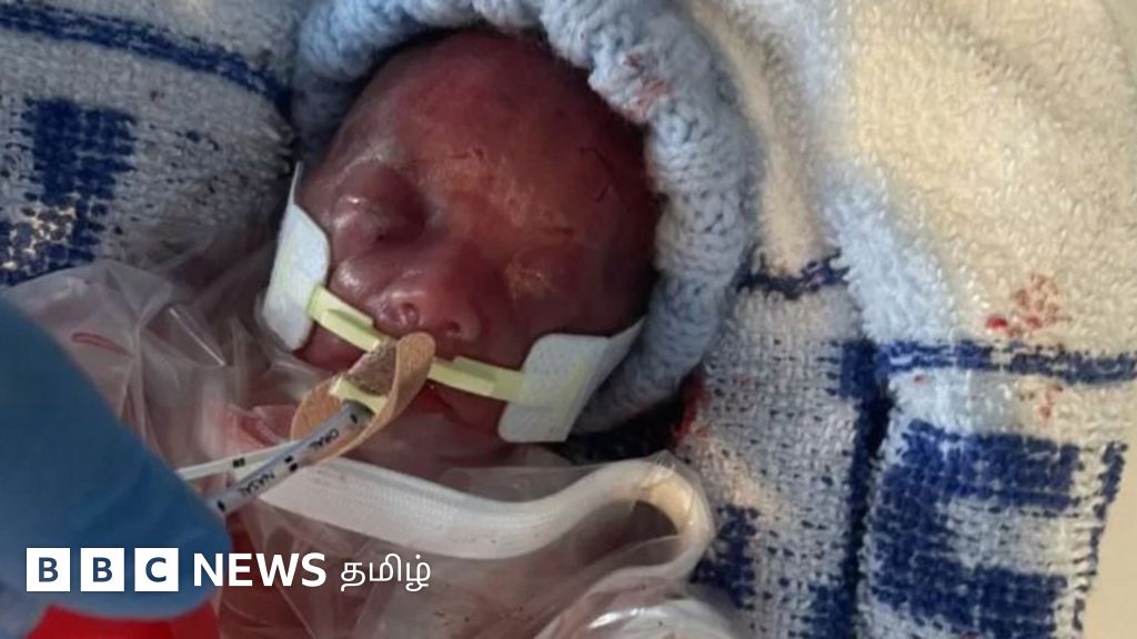 அரை கிலோ எடையில் 5வது மாதத்திலேயே பிறந்த குழந்தை உயிர் பிழைத்தது எப்படி?