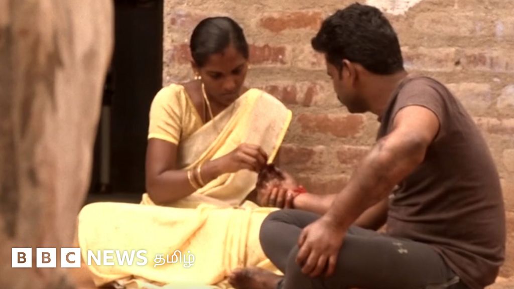 கை மாற்று அறுவை சிகிச்சையும், கைவிடாத காதலும்: அரசு மருத்துவமனையின் சாதனை