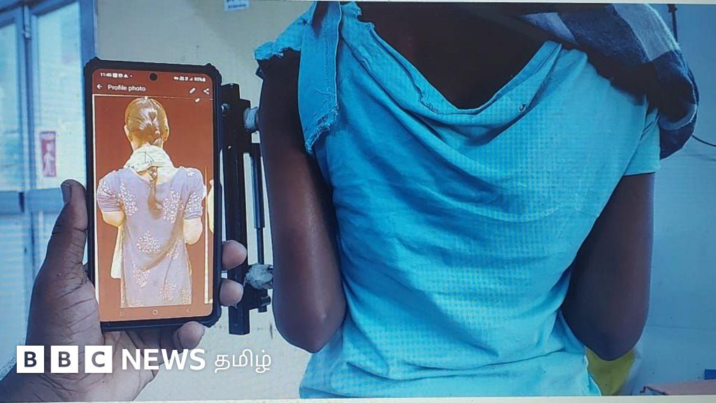 பெண்ணுக்கு 14 செ.மீ. எலும்பை வளரவைத்த திண்டிவனம் அரசு மருத்துவர்கள் - எப்படி சாத்தியமானது?